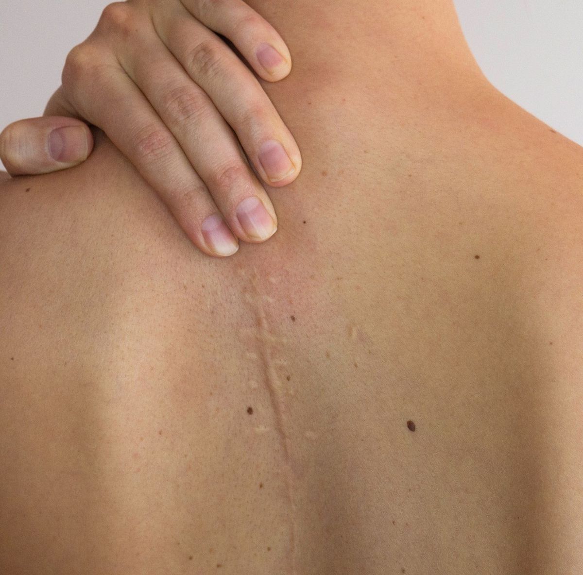 Atenuación de cicatrices en Mosquera - Tratamiento especializado